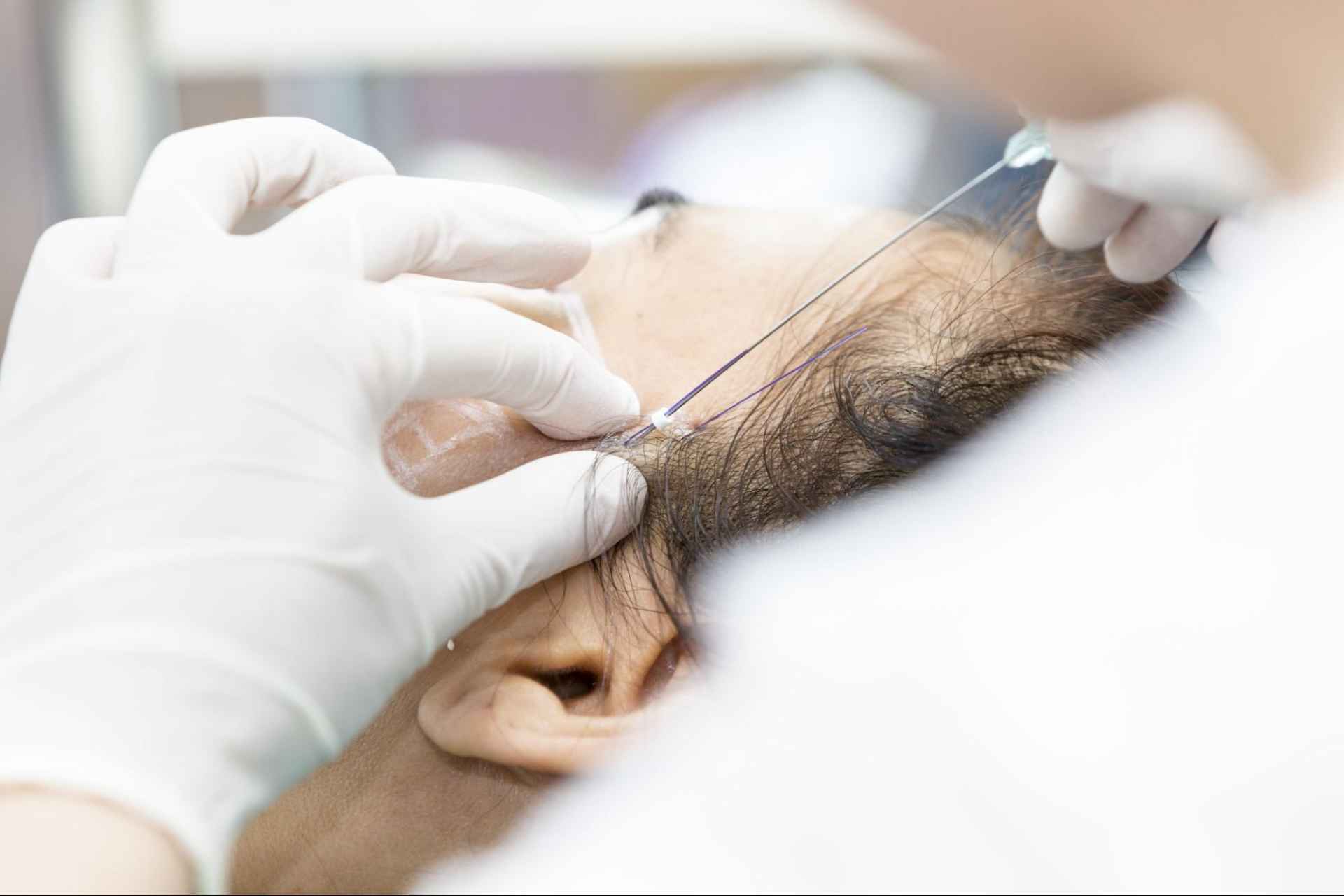 ร้อยไหม ที่ไหนดี วิธีเลือกคลินิกที่เชื่อถือได้